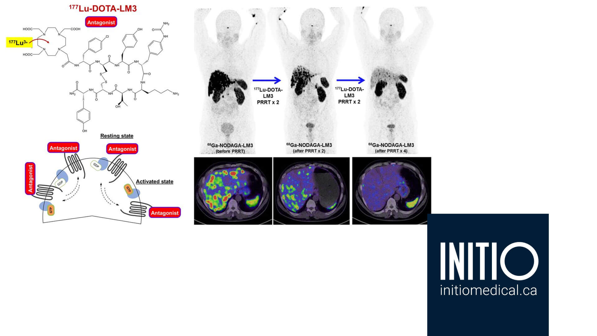 on the far left, the patient's liver is full of metastatic disease, which is cancer spread, from a gastrointestinal cancer. After they start receiving the agent, notice the liver with fewer and fewer dark spots, as the agent destroys the cancer cells while leaving healthy liver tissue unharmed