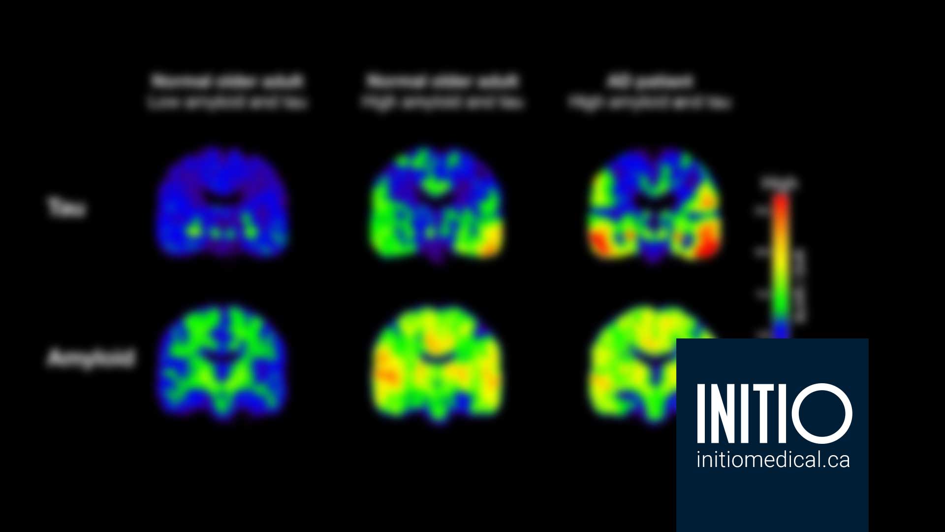 PET tracer may improve understanding of Alzheimer’s Disease