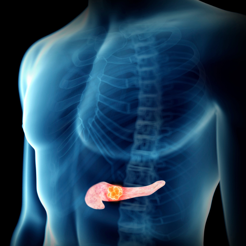 Alpha Tau treats first patient in pancreatic cancer feasibility study